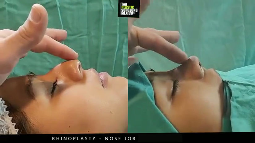 Nose Job - Rhinoplasty in Mexico - TopPlasticSurgeonsMexico 3
